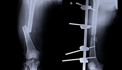 Osteosynthesis device